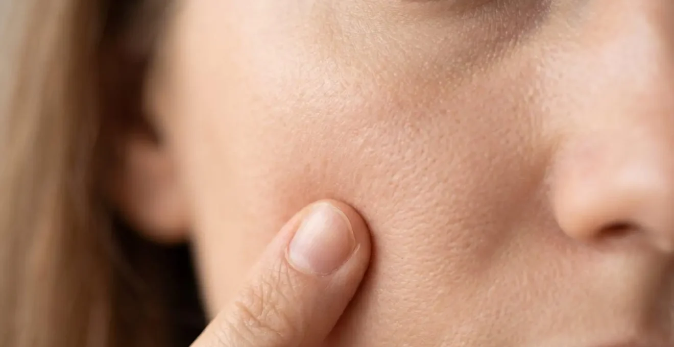 Applicazione protezione solare SPF 50+ dopo peeling enzimatico per prevenire iperpigmentazione
