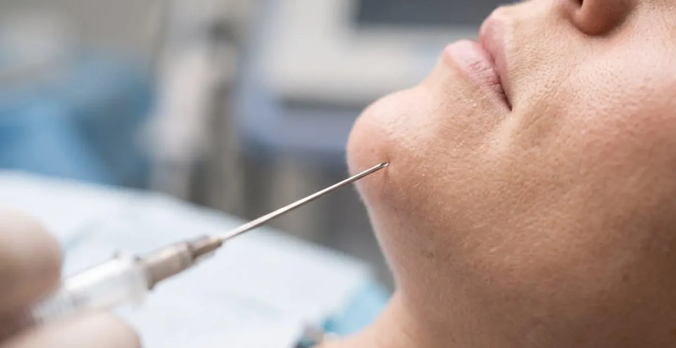 Dettaglio anatomico dell'iniezione di filler al mento con tecnica professionale